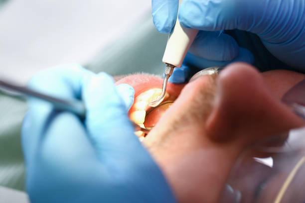 Best Emergency Tooth Extraction in Davis, CA